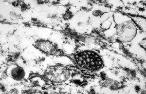 M,59y. | endothelial Weibel-Palade tubular body - angiomatous tumor, v.s.Kaposi